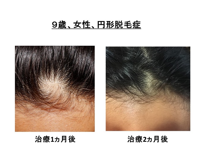 円形脱毛症　病院